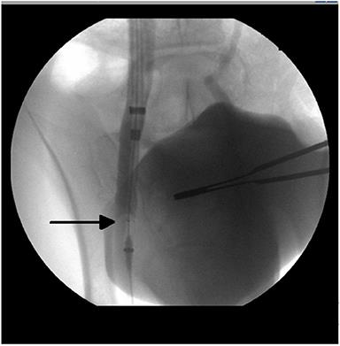 Fatal Ovarian Hemorrhage Associated With Anticoagulation Therapy in a Yucatan Mini-Pig Following Venous Stent Implantation